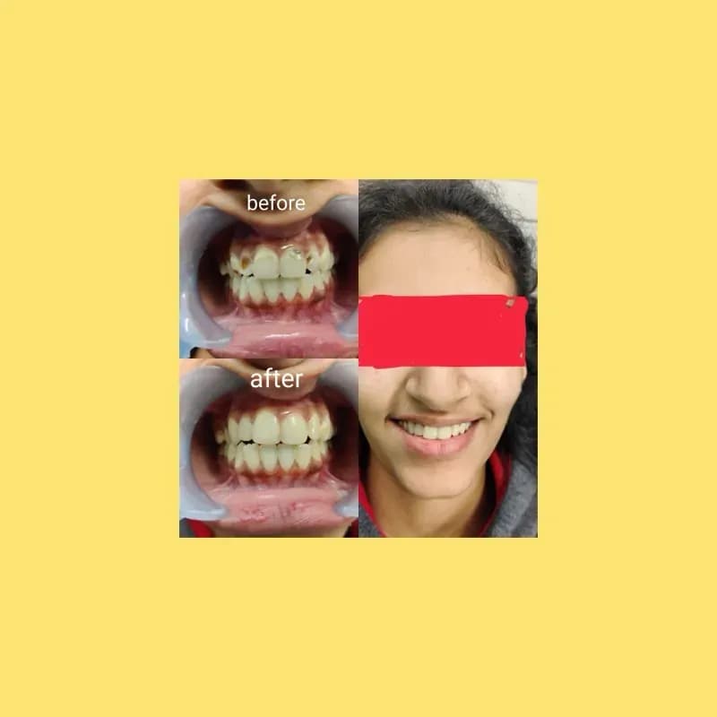 Before and after orthodontic treatment - teeth alignment correction