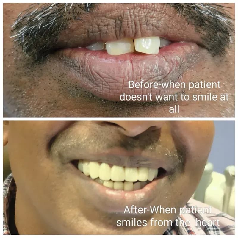 Before and after smile restoration - dental implants and crowns