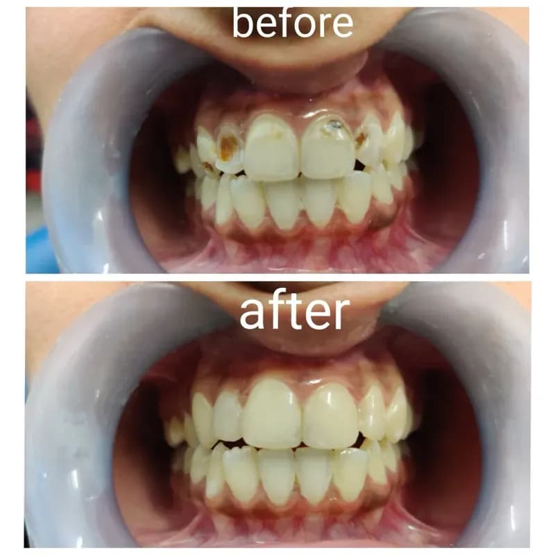 Before and after dental restoration - cavity and decay treatment