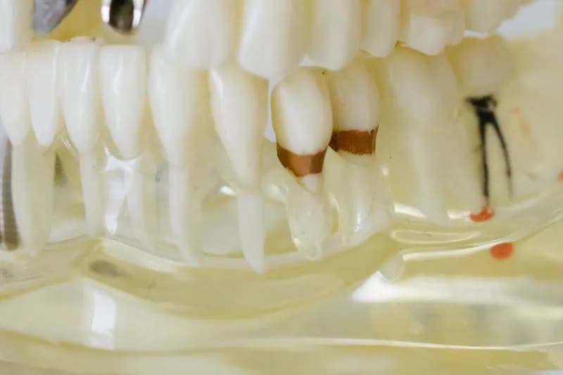 Wisdom Tooth Extraction
